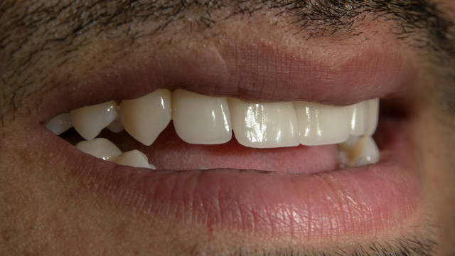 Comment ne pas avoir les dents jaunes ?